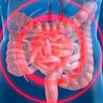 Enfermedad de Crohn: qué es lo padece el polémico youtuber MrBeast